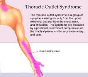 Thoracic Outlet Syndrome and Chiropractic